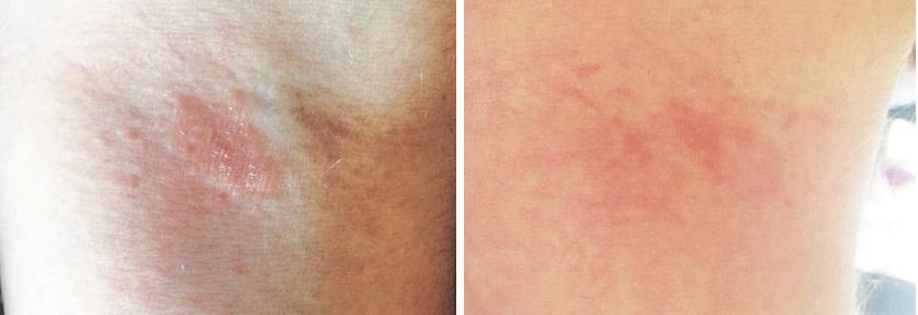 Atópiás dermatitisz tünetei és kezelése - HáziPatika